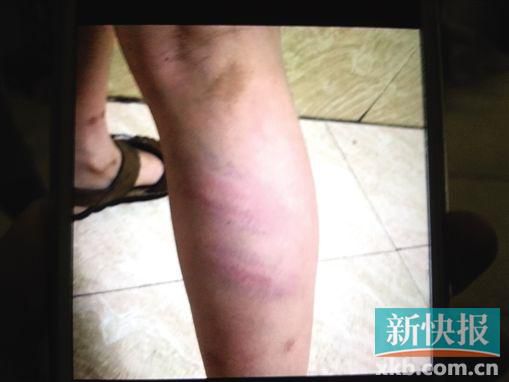小宇腿部有明顯瘀痕。 翻拍自家屬手機