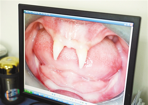 貴州:16歲男孩身患罕見基因病只長(zhǎng)兩顆“獠牙” 貴州:16歲男孩身患罕見基因病只長(zhǎng)兩顆“獠牙”