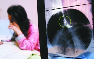 假牙上的鋼絲刺破食管，而薄薄的食道壁緊貼主動(dòng)脈血管，極易造成血管破裂