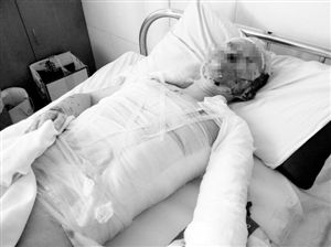 周小姐的頭、頸、軀干、四肢均被燒傷，其中面部燒傷最為嚴(yán)重。