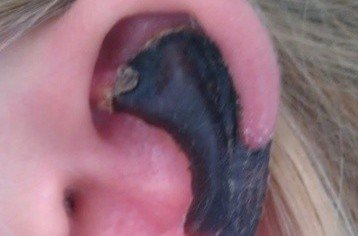 荷蘭女子旅游途中被蜘蛛咬，耳軟骨溶解變黑。