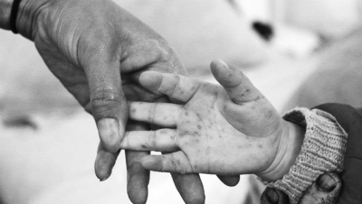 手足口病進(jìn)入高發(fā)季 河南省幼兒園開(kāi)始每日晨檢 手足口病進(jìn)入高發(fā)季 河南省幼兒園開(kāi)始每日晨檢