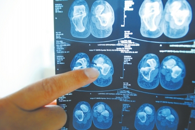 X光片顯示,確實(shí)有一根殘留的螺絲釘。