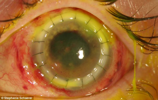 恐怖慎入！隱形眼鏡致英女子摘除眼球