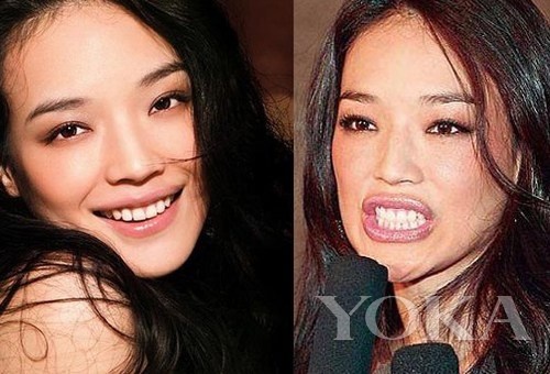 牙齒凸出，口輪肌過于松弛