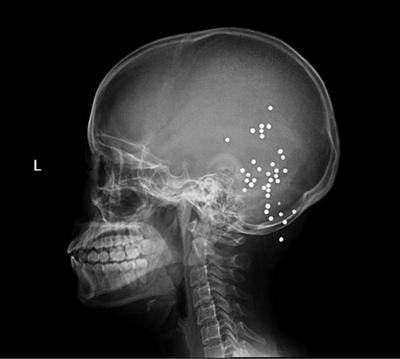 X射線顯示的子彈位置 X射線顯示的子彈位置