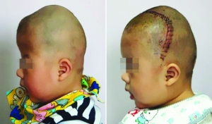 術(shù)前（左），術(shù)后（右）