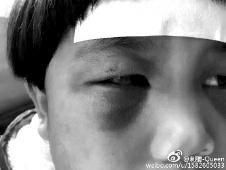 6月2日，網(wǎng)曝渭南市臨渭區(qū)一不滿5歲的女童遭奶奶毆打，眼圈青腫，引起網(wǎng)友關(guān)注，但孩子父母和爺爺均稱是摔倒導(dǎo)致。相關(guān)部門介入調(diào)查發(fā)現(xiàn)確為奶奶毆打所致，鑒于其身體原因已進行批評教育。