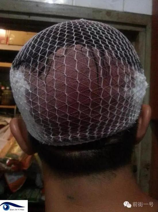 李律師受傷后縫合三針。