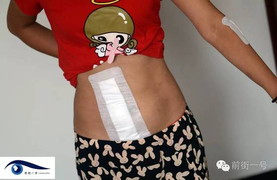 小金腹部的傷口。