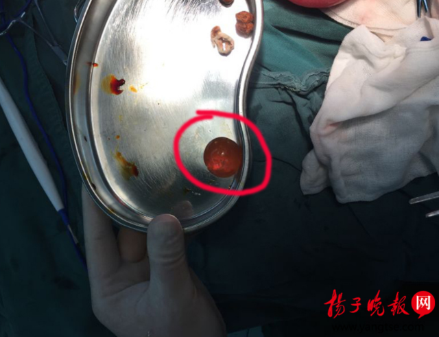 淮安1歲男童誤食水寶寶 取出時(shí)如乒乓球大小