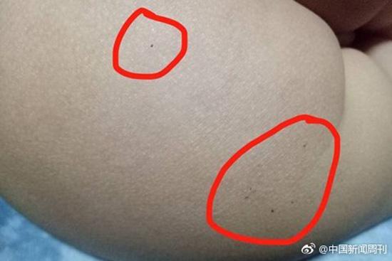 據(jù)多名紅黃藍(lán)(新天地分園)家長(zhǎng)反映，孩子腿部、屁股、腋下出現(xiàn)針眼。