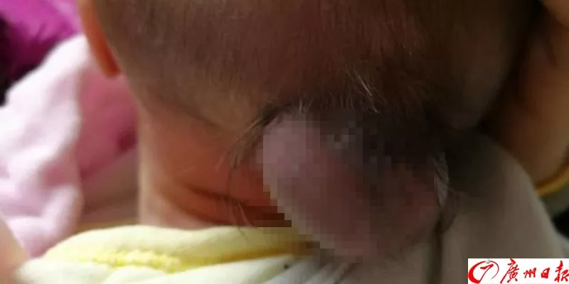 剛出生的男嬰腦袋上長出尾巴 只因孕媽沒做這事 剛出生的男嬰腦袋上長出尾巴 只因孕媽沒做這事
