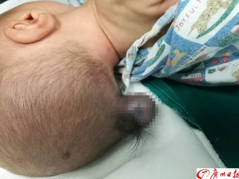 剛出生的男嬰腦袋上長出尾巴 只因孕媽沒做這事 剛出生的男嬰腦袋上長出尾巴 只因孕媽沒做這事