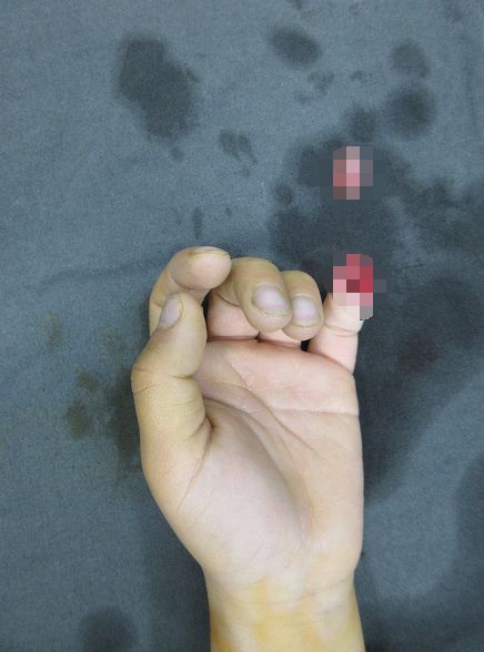 嚇哭！6歲男孩被夾斷手指 罪魁禍首竟是校服