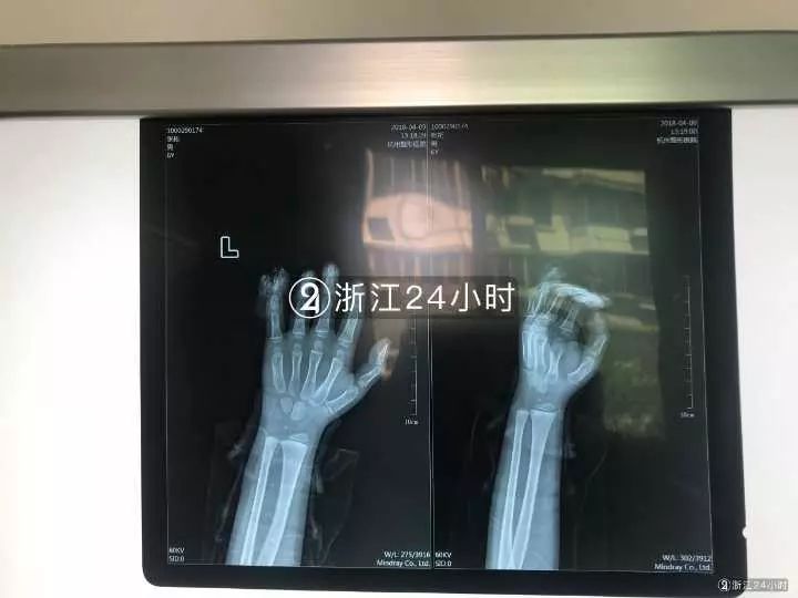 嚇哭！6歲男孩被夾斷手指 罪魁禍首竟是校服