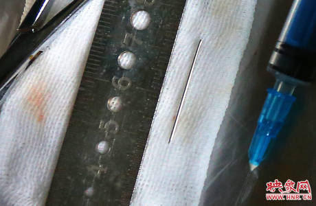 駐馬店失明雙胞胎手術成功 駐馬店失明雙胞胎手術成功