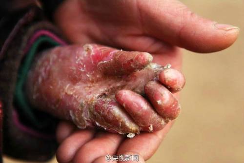 男孩皮膚一碰就破 裹衛(wèi)生紙堅持上學(xué) 男孩皮膚一碰就破 裹衛(wèi)生紙堅持上學(xué)