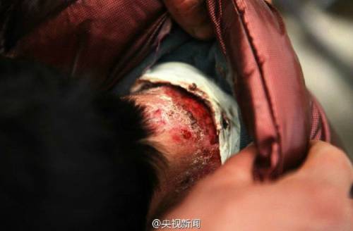 男孩皮膚一碰就破 裹衛(wèi)生紙堅持上學(xué) 男孩皮膚一碰就破 裹衛(wèi)生紙堅持上學(xué)