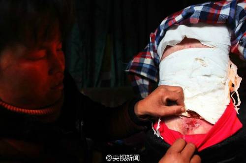 男孩皮膚一碰就破 裹衛(wèi)生紙堅持上學(xué) 男孩皮膚一碰就破 裹衛(wèi)生紙堅持上學(xué)