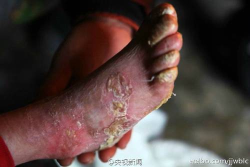 男孩皮膚一碰就破 裹衛(wèi)生紙堅持上學(xué) 男孩皮膚一碰就破 裹衛(wèi)生紙堅持上學(xué)