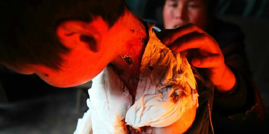 男孩皮膚一碰就破 裹衛(wèi)生紙堅持上學(xué) 男孩皮膚一碰就破 裹衛(wèi)生紙堅持上學(xué)