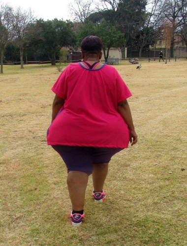 南非50歲女子臀部異常肥大遭歧視 南非50歲女子臀部異常肥大遭歧視