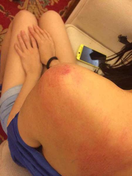 “跑男”真的很拼！baby朋友圈曬后背紅腫照