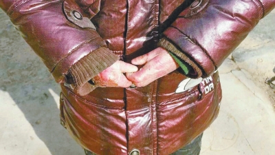 長期受損的手指，已經(jīng)長在了一起。