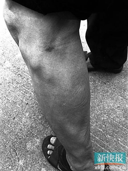 傷者身上遺留的彈痕。