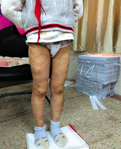 4月3日晚，微博網(wǎng)友“@朝廷半日閑”發(fā)圖文微博展示男童被虐待的慘狀。 微博截圖