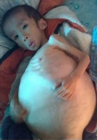 湖北5歲男孩患怪病肚子長成“大冬瓜”(圖) 湖北5歲男孩患怪病肚子長成“大冬瓜”(圖)