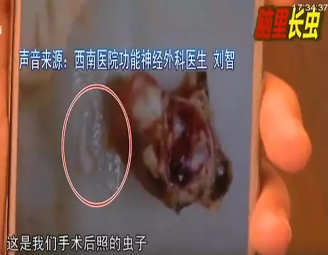 少女大腦皮層萎縮 醫(yī)生從她腦子里捉出5厘米蟲子 少女大腦皮層萎縮 醫(yī)生從她腦子里捉出5厘米蟲子