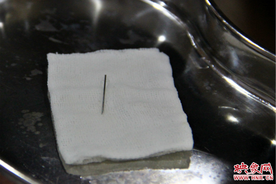 上午11點30分許，小龍腦中鋼針已經(jīng)成功取出。