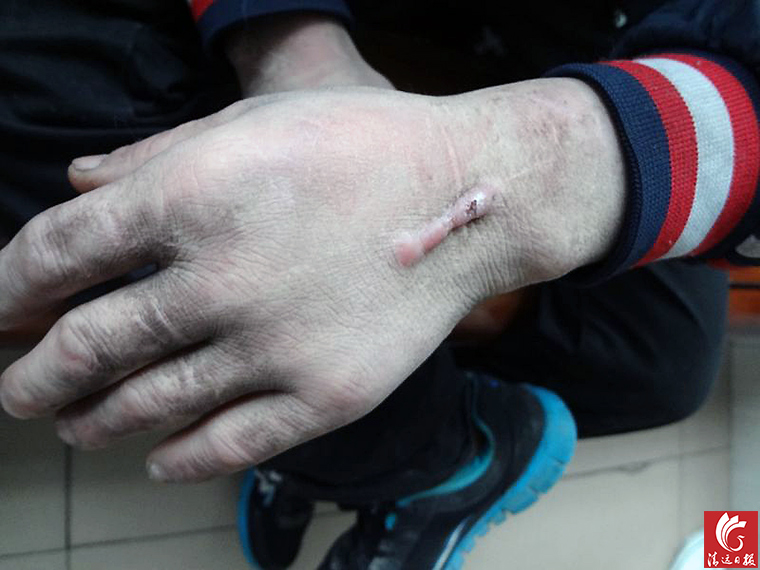 被發(fā)現(xiàn)男子手上的傷疤。