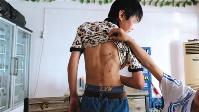 　昨日，奶西村，被打的小剛后背上條條瘀痕依然明顯。