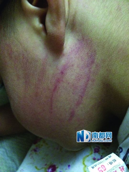 小逸臉上淤痕清晰可見。