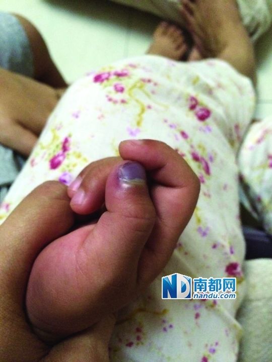 小逸手指被夾傷。