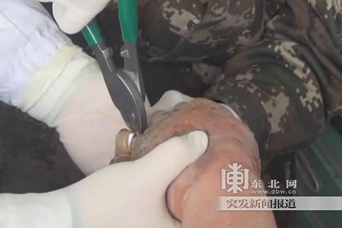 正在拆除戒指。