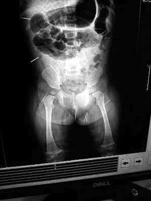 目前體內(nèi)的12根鋼針多分布在孩子的臀部，一根在腹部，其余3根在胸腔附近，其中一根很接近心臟