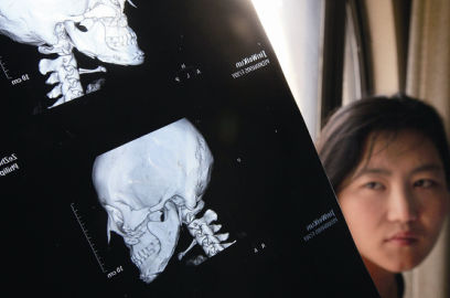 國內(nèi)醫(yī)院CT顯示，如今靳魏坤的鼻子假體是歪的，連下巴也是歪的