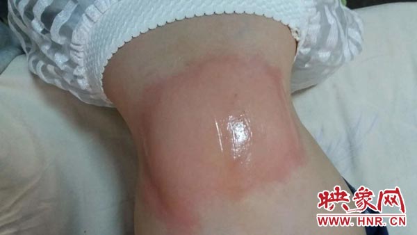 緯三路小學(xué)一名學(xué)生身上出現(xiàn)的不適癥狀 緯三路小學(xué)一名學(xué)生身上出現(xiàn)的不適癥狀