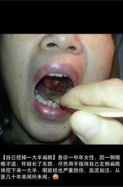 圖片來(lái)自市三醫(yī)院耳鼻喉科醫(yī)生朋友圈 圖片來(lái)自市三醫(yī)院耳鼻喉科醫(yī)生朋友圈