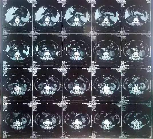 55歲大爺因愛吃豆腐 體內(nèi)取出420顆結(jié)石 55歲大爺因愛吃豆腐 體內(nèi)取出420顆結(jié)石