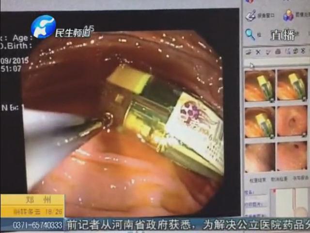 倆螺絲一個打火機 胃里發(fā)現的